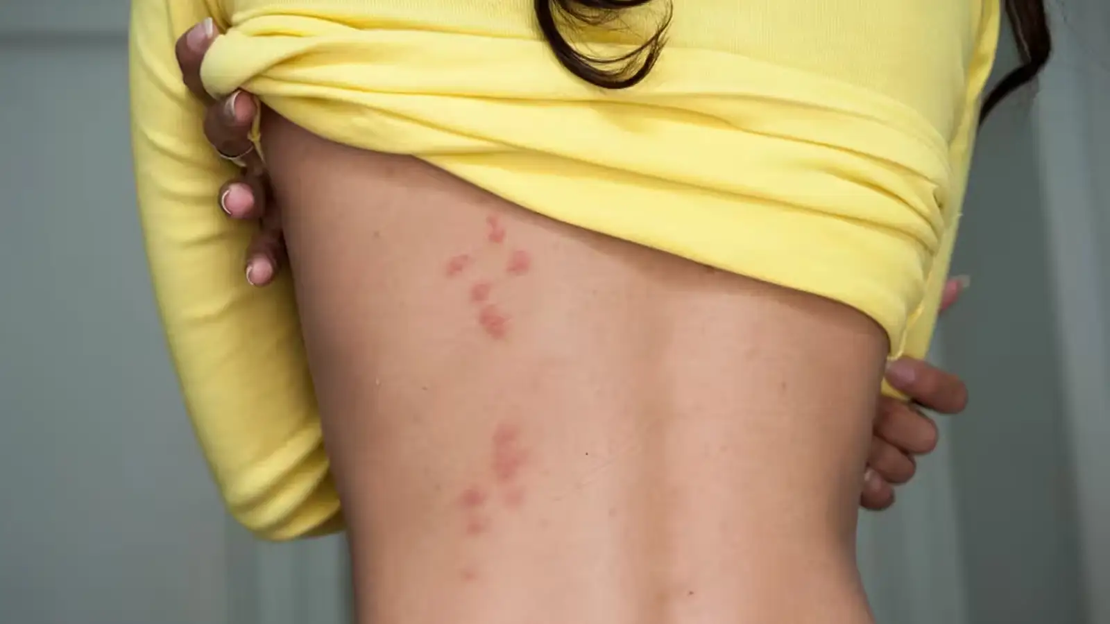 Bettwanzenbisse erkennen – Bilder, Symptome & Verwechslung